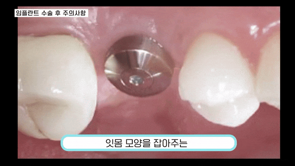 강남역임플란트수술 달라지는 일상의 즐거움 관련 이미지 5