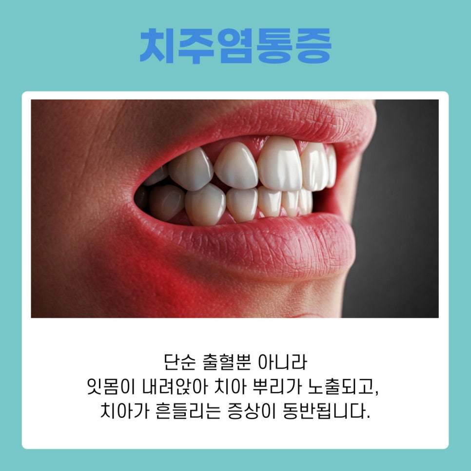 서초동치과 잇몸 출혈 방치하면 안되는 이유 관련 이미지 6