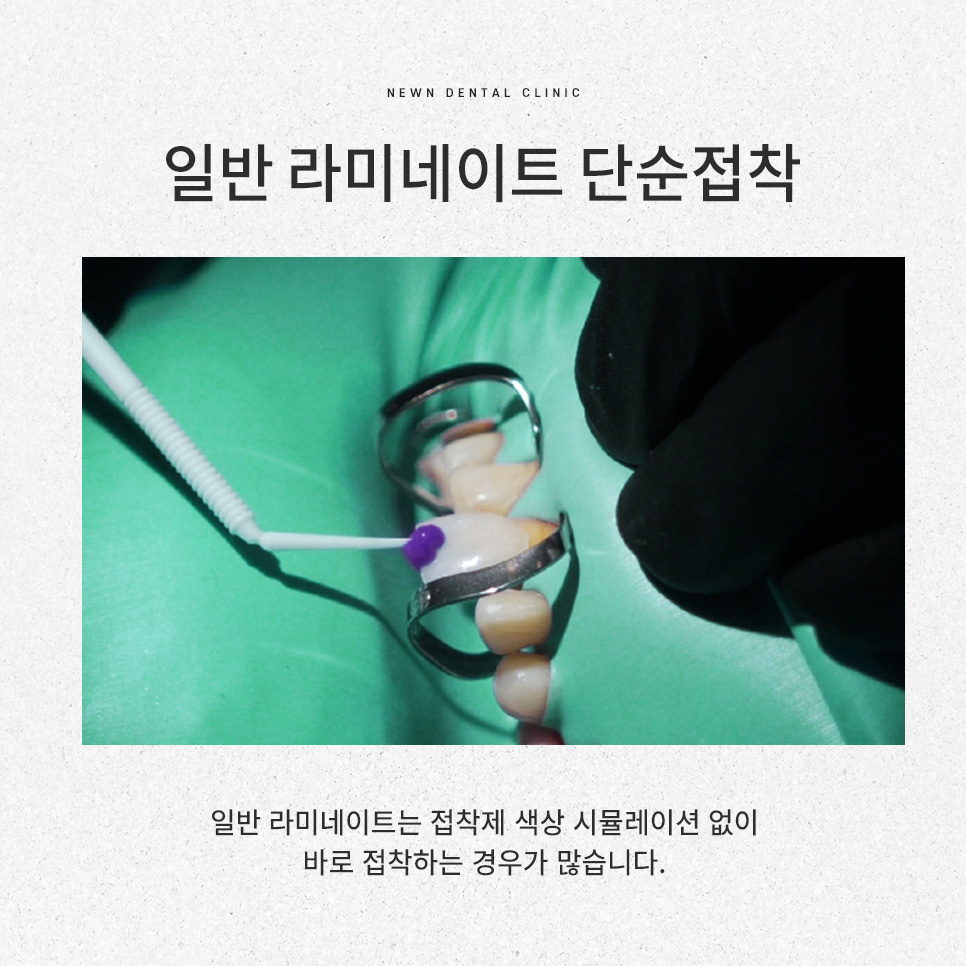 강남역 뉴엔치과 일반 라미네이트와 퍼스널라미의 차이점 관련 이미지 15