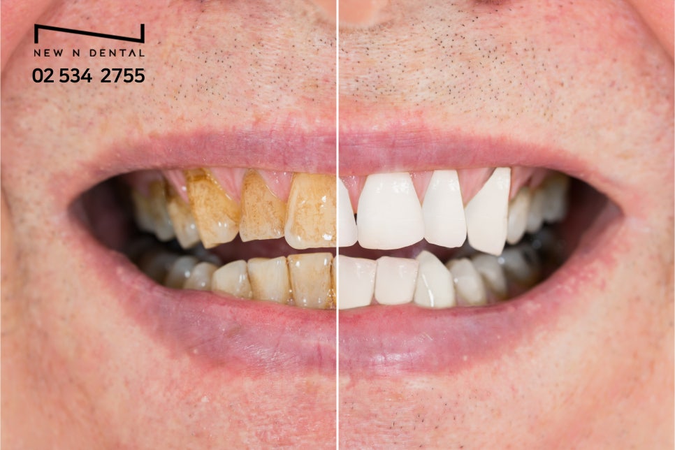 강남치아미백 밝고 투명한 자신감 관련 이미지 4