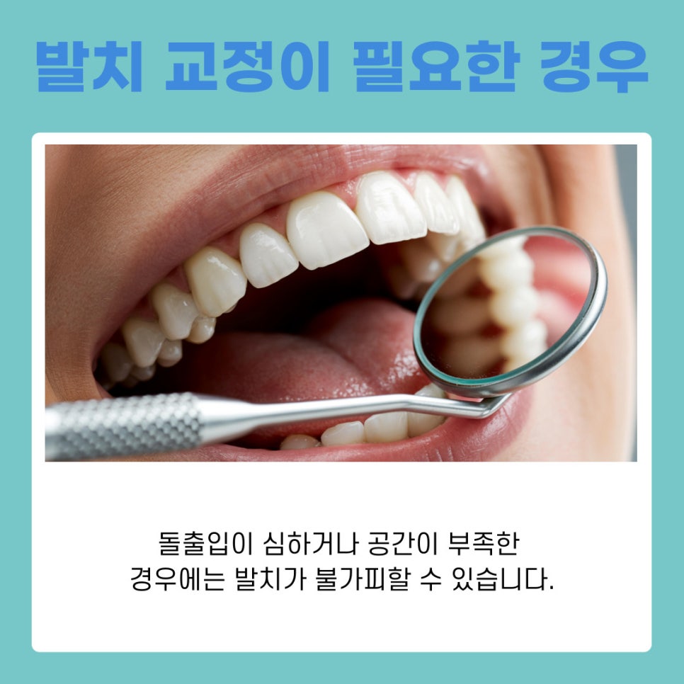 논현역치과 돌출입 치아 교정 비발치로 가능 할까? 관련 이미지 6