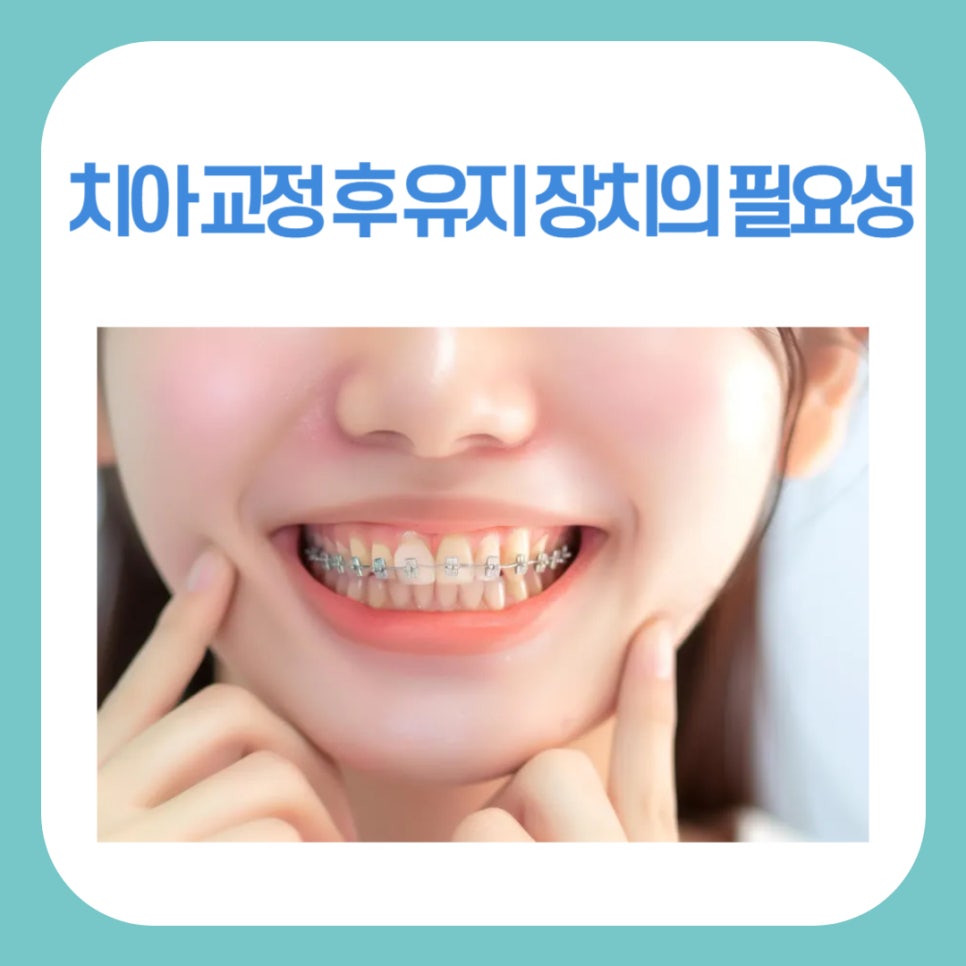 치아교정 후 유지 장치의 필요성 관련 이미지 1
