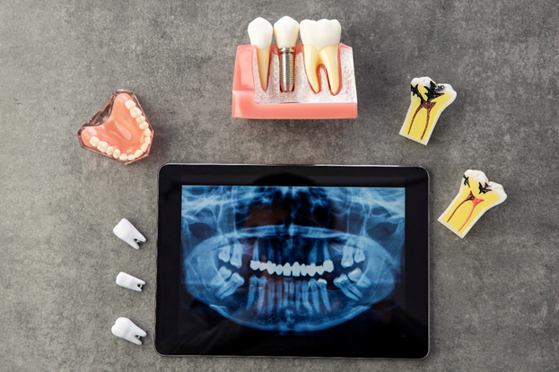 서초임플란트 경험과 디지털로 명확하게 관련 이미지 8