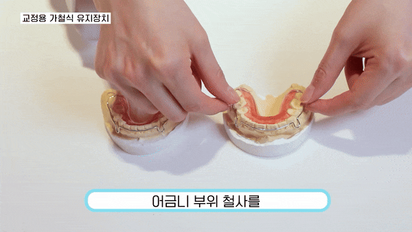 강남역교정치과 개인별 맞춤으로 견고하게 관련 이미지 5