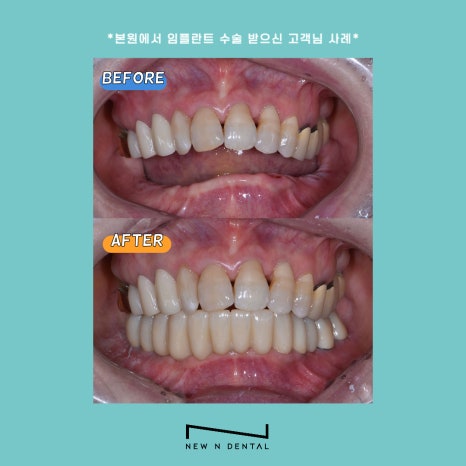 신논현역임플란트 건강하고 오래쓰는 임플란트 관련 이미지 9