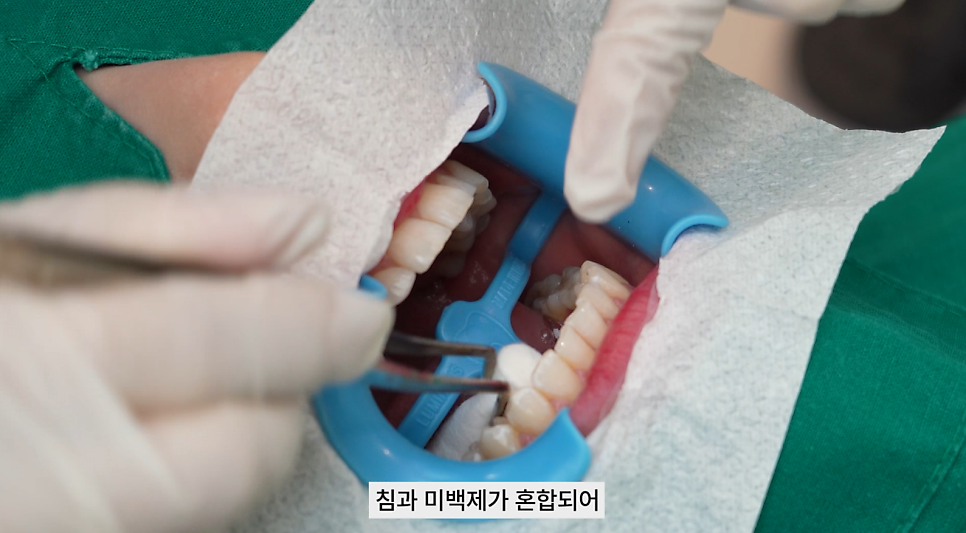 강남치과 원데이치아미백 누런치아 탈출 관련 이미지 5