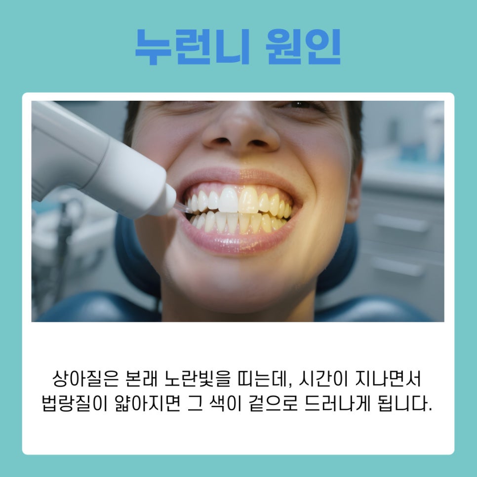 강남역 치아미백 누런니 고민해결 밝은 미소 되찾는 법 관련 이미지 3