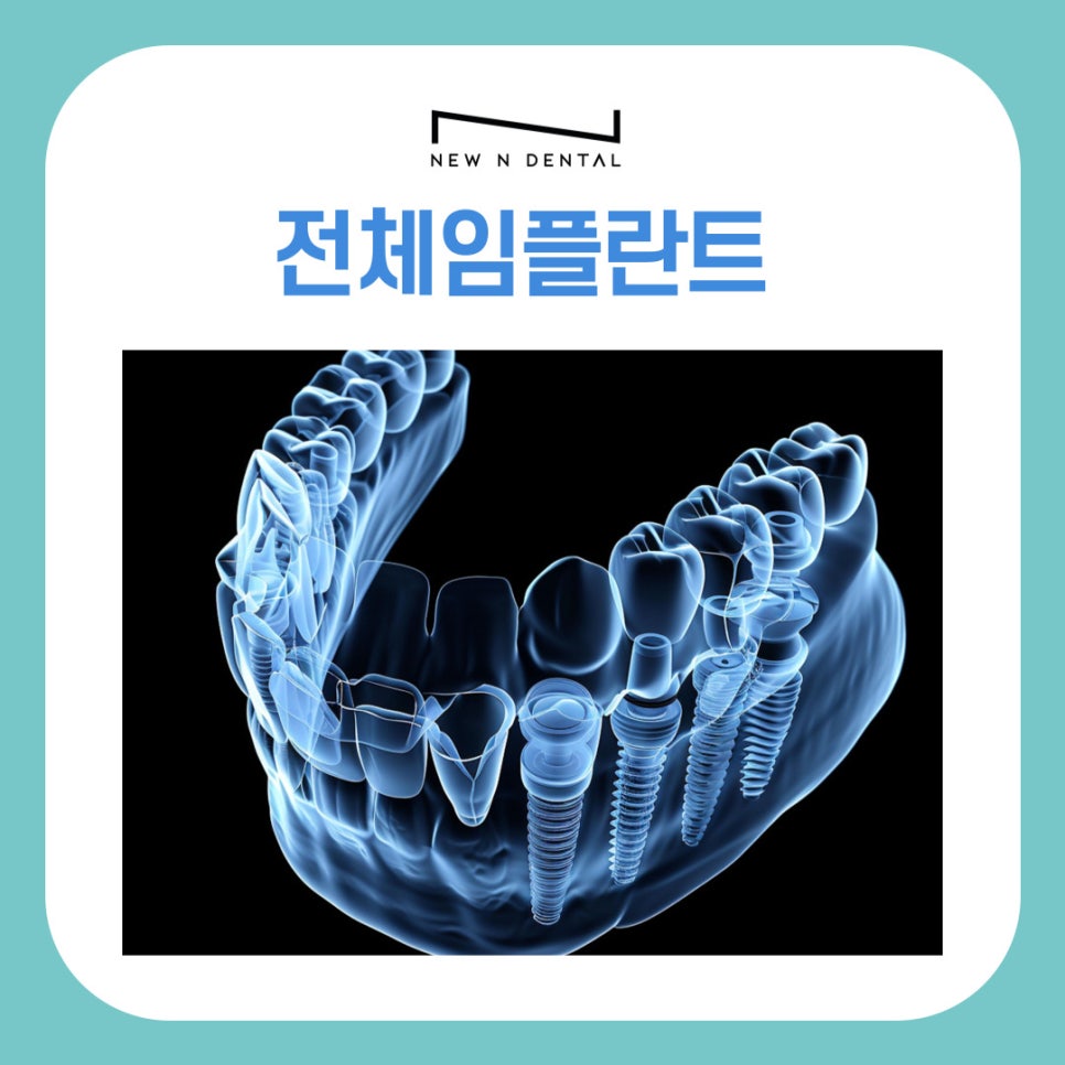 강남역 치과 전체임플란트 추천 어떤 분들이 대상일까? 관련 이미지 2
