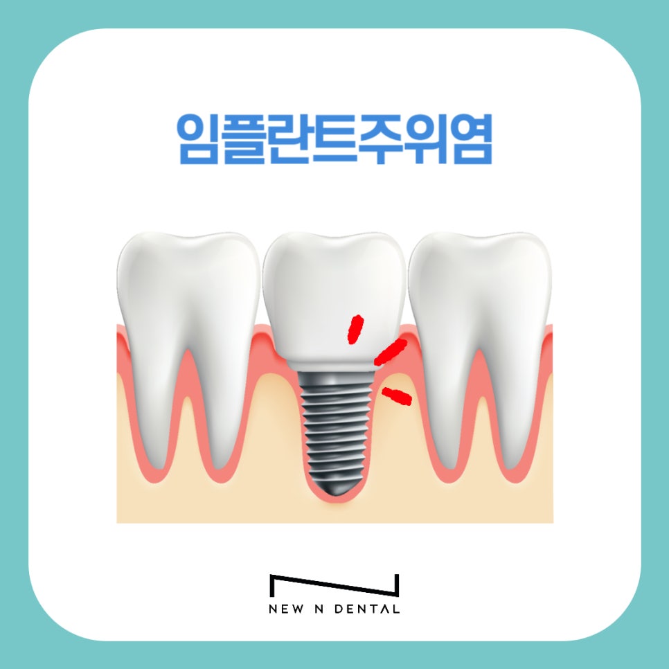 신논현역치과 임플란트주위염 예방방법은 관련 이미지 1