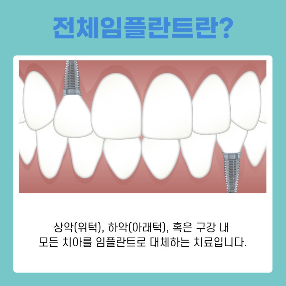강남역 치과 전체임플란트 추천 어떤 분들이 대상일까? 관련 이미지 3