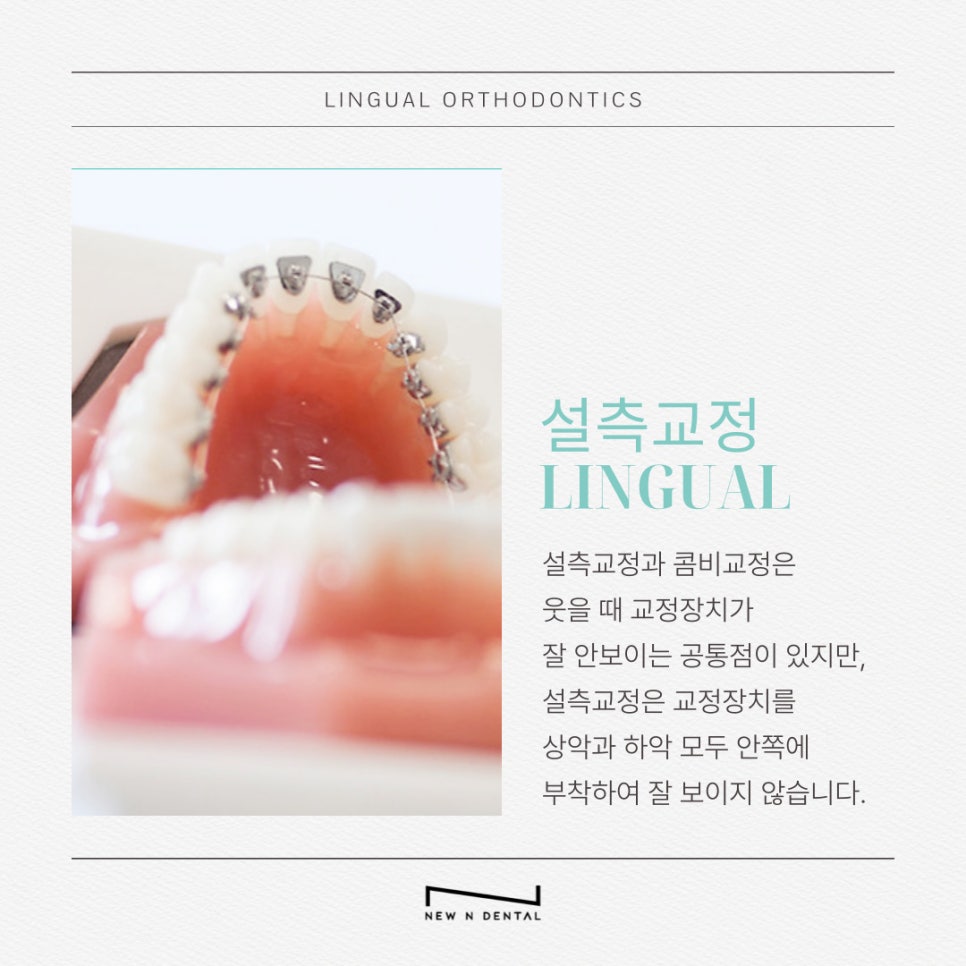 강남역치아교정치과 여러 가지 방법과 장점은? 관련 이미지 10