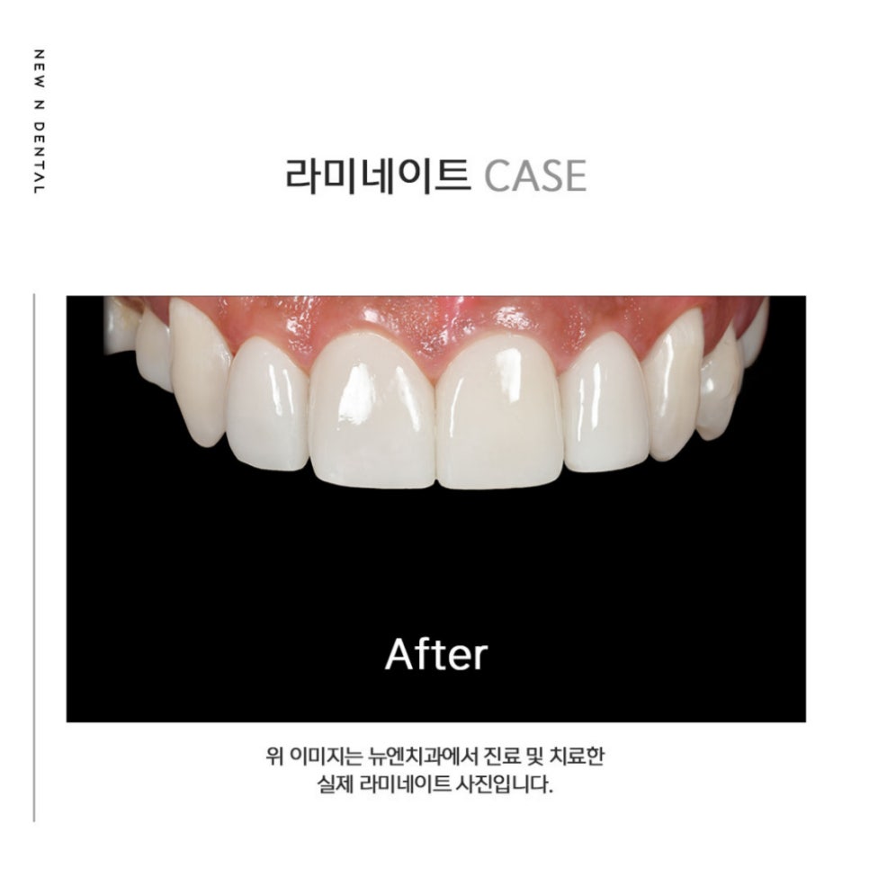 자연치아를 최대한 보호하는 최소삭제라미네이트 관련 이미지 12