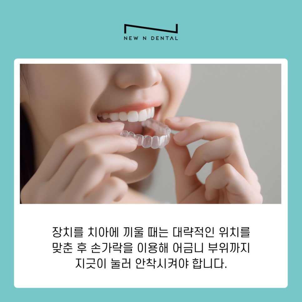 From the Features of Clear Aligners in Gangnam to How to Care for the Appliances image 10