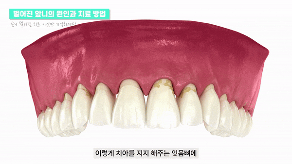 서울라미네이트치과 검색후 뉴엔치과에 오시는 진짜 이유 관련 이미지 3