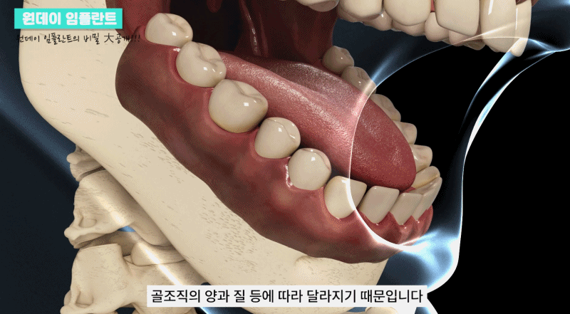 강남 당일임플란트 가능한 곳 뉴엔치과에서 관련 이미지 9