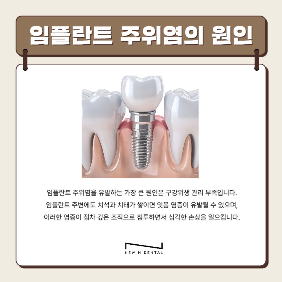 강남역 임플란트 치과 임플란트주위염 원인,증상,치료방법 관련 이미지 3