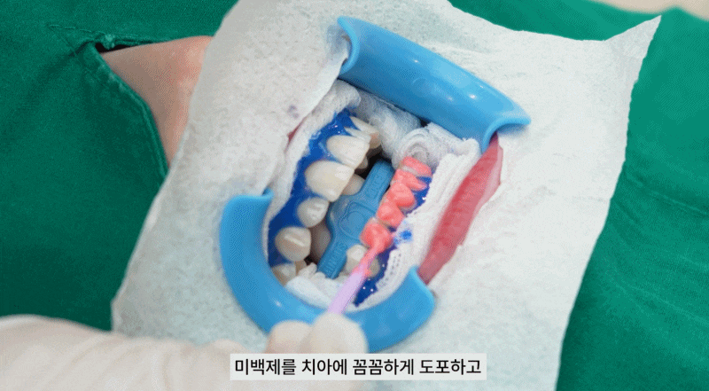 강남치과 원데이치아미백 누런치아 탈출 관련 이미지 9