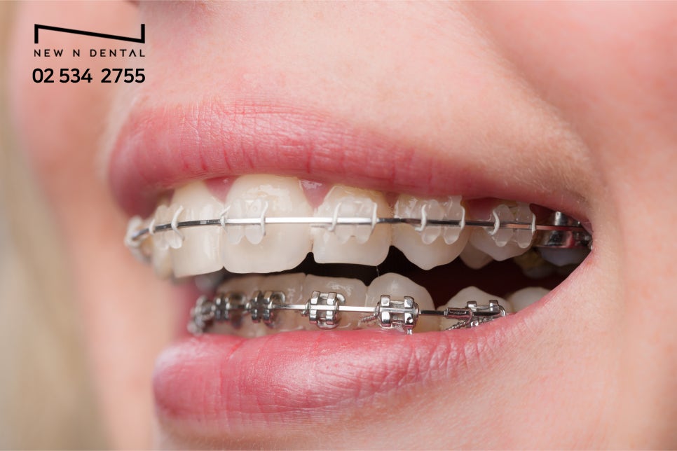 앞니벌어짐교정 나에게 맞는 방법 선택 관련 이미지 4