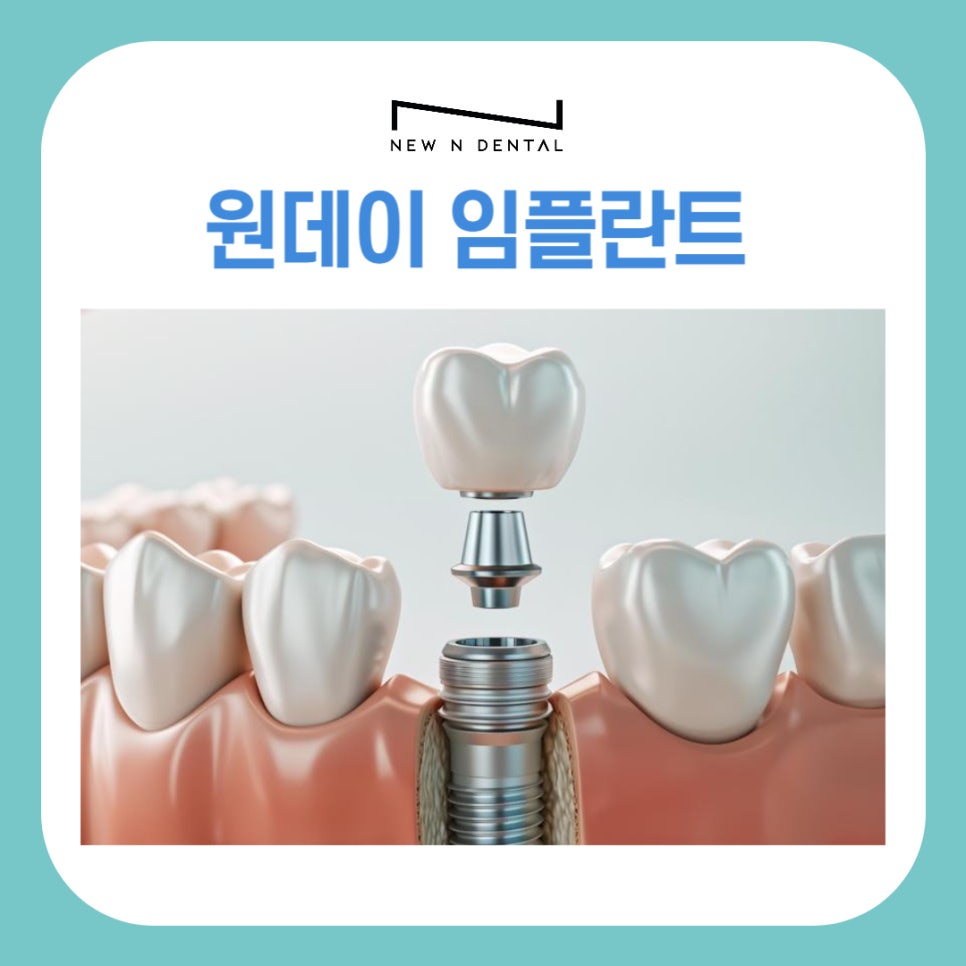 원데이 임플란트 빠르게 치료하려면 관련 이미지 2