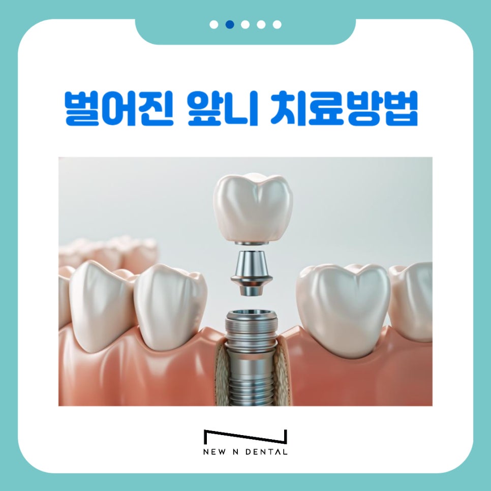 강남역치과 앞니 벌어짐 원인, 치료와 방법 관련 이미지 15