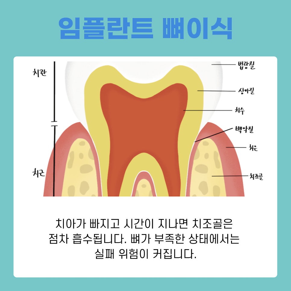 강남역치과 임플란트 뼈이식, 흡연과 음주가 미치는 영향은? 관련 이미지 3