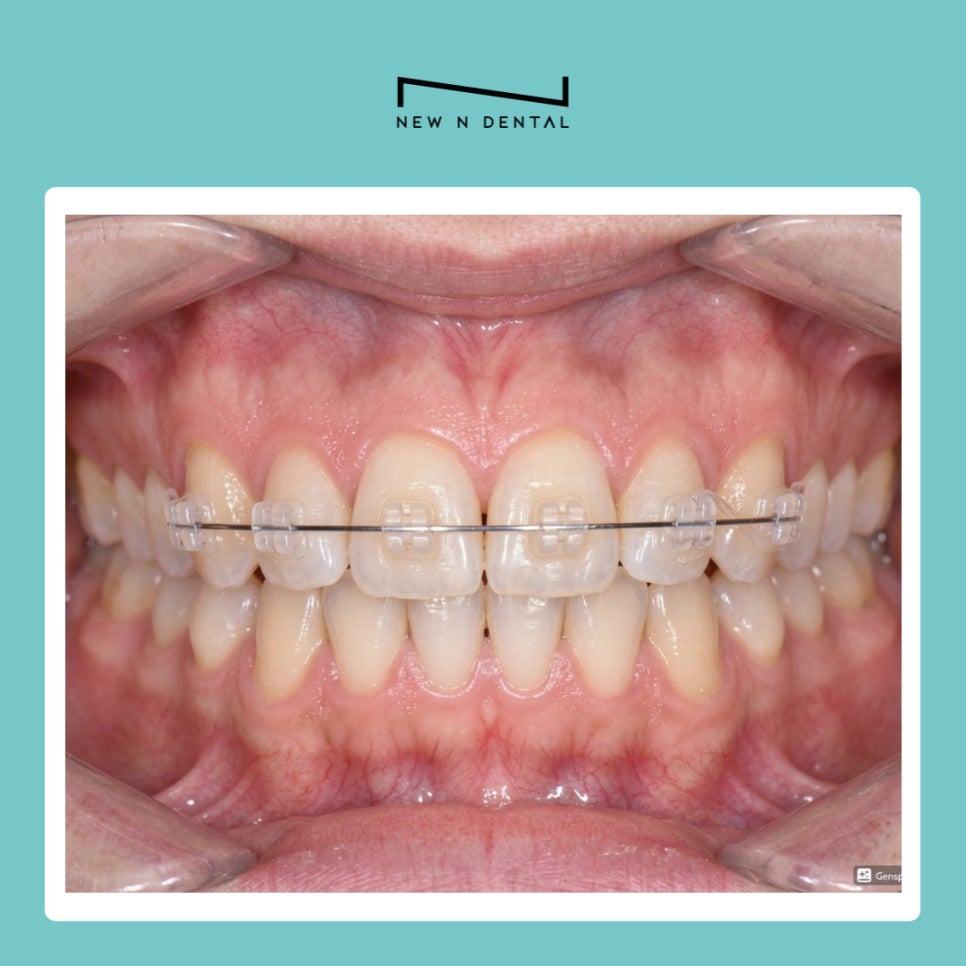 서초구치과에서 벌어진 앞니 교정 나에게 맞는 치료 알아보기 관련 이미지 5