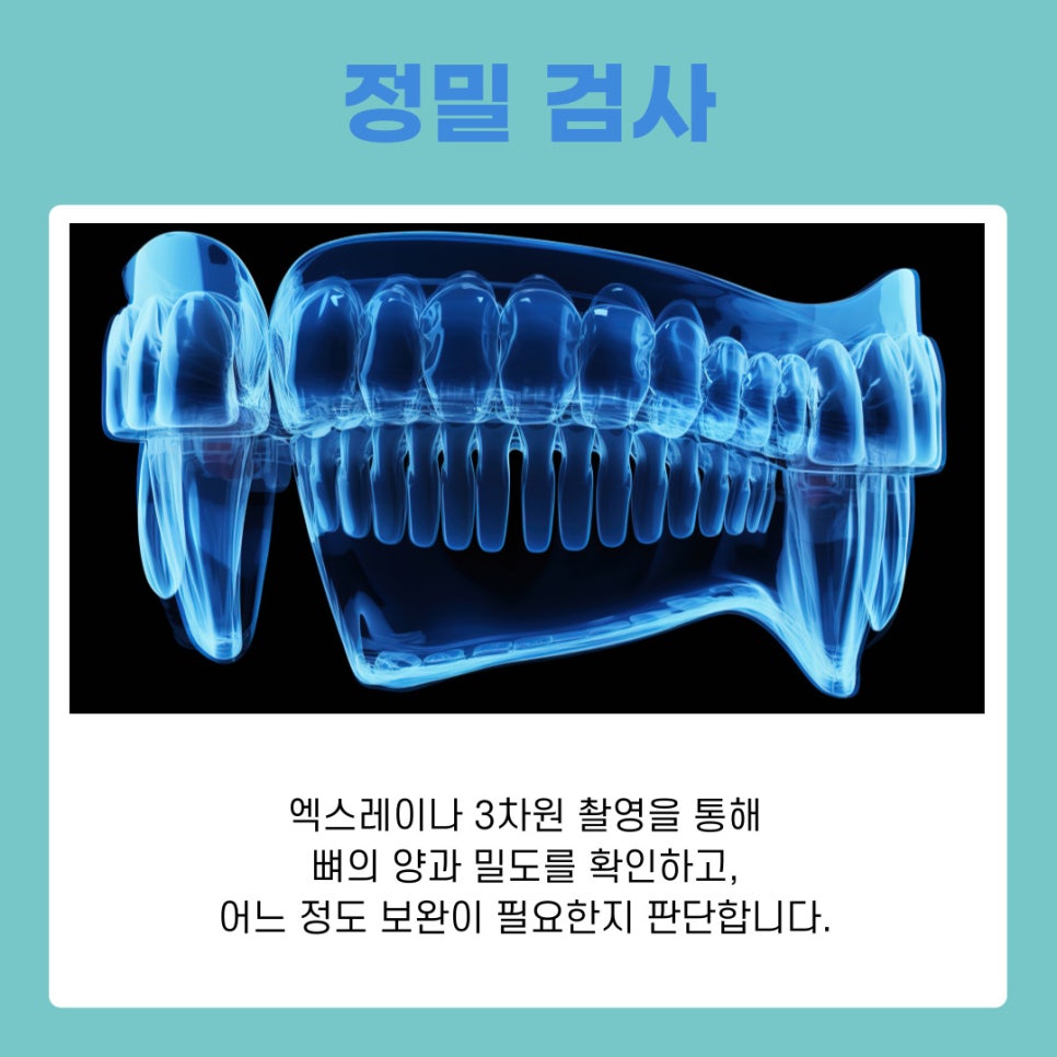 강남 역삼동 임플란트 뼈이식 과정과 회복 기간 이것만 알면 끝 관련 이미지 3