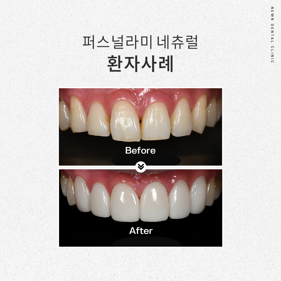 퍼스널라미 네츄럴ㅣ자연스러운 미소를 찾아주는 앞니성형, 무삭제 라미네이트 관련 이미지 11