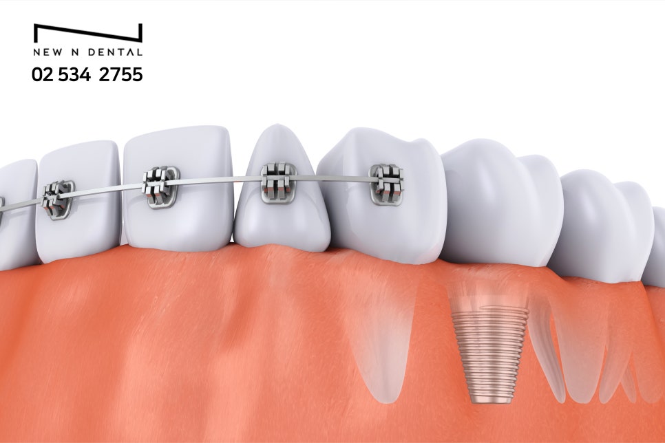 오스템SOI 견고한 골유착으로 오래가는 임플란트 관련 이미지 6