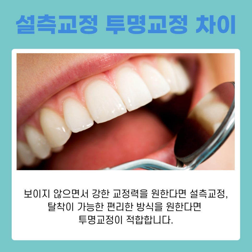 Orthodontics Near Gangnam Station: Differences Between Anterior Lingual Braces and Clear Aligners by Type image 8