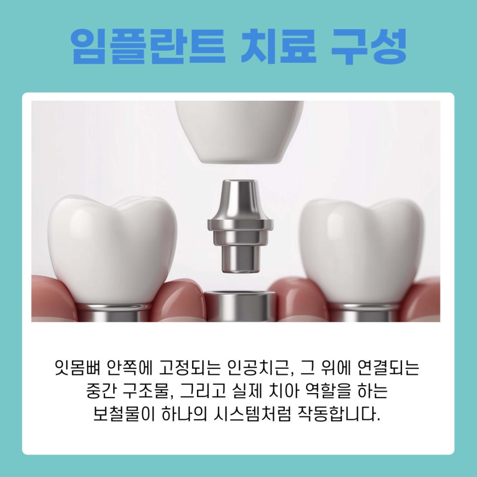 반포역치과 임플란트 치료 기간과 회복 과정 관련 이미지 3