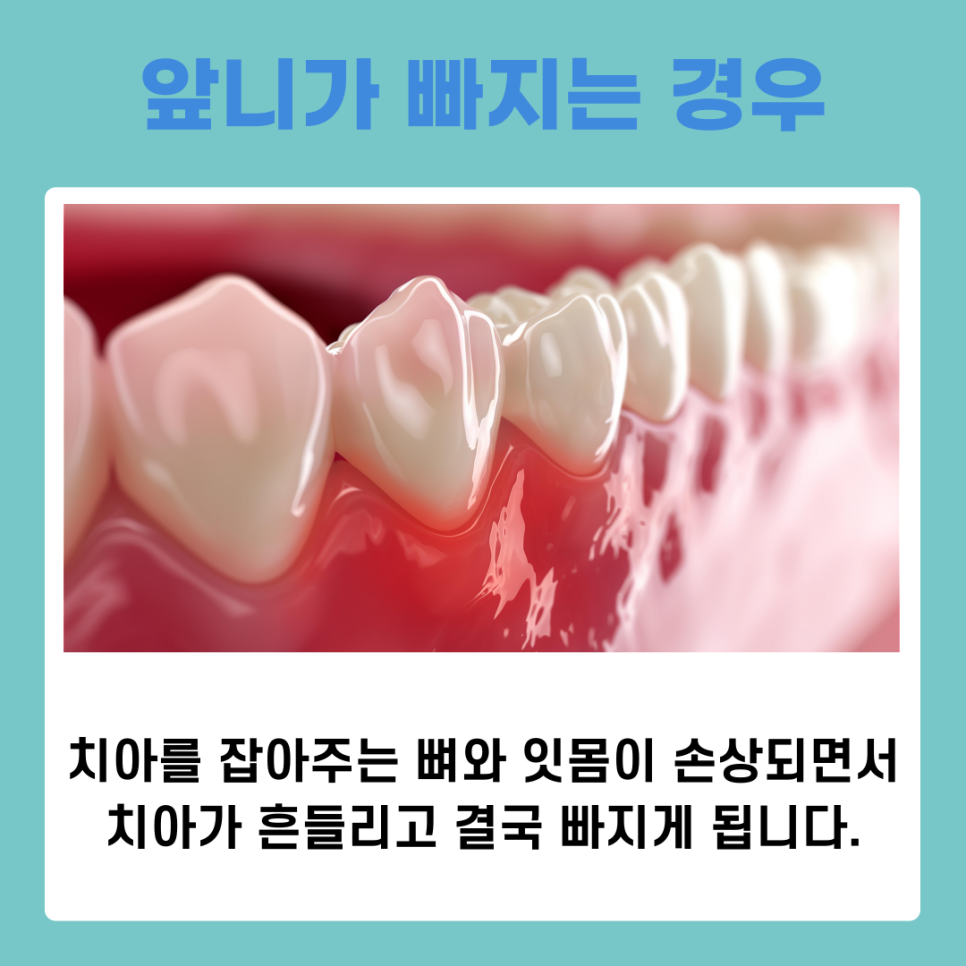 앞니 임플란트 식립 주의해야 할 사항은? 관련 이미지 4
