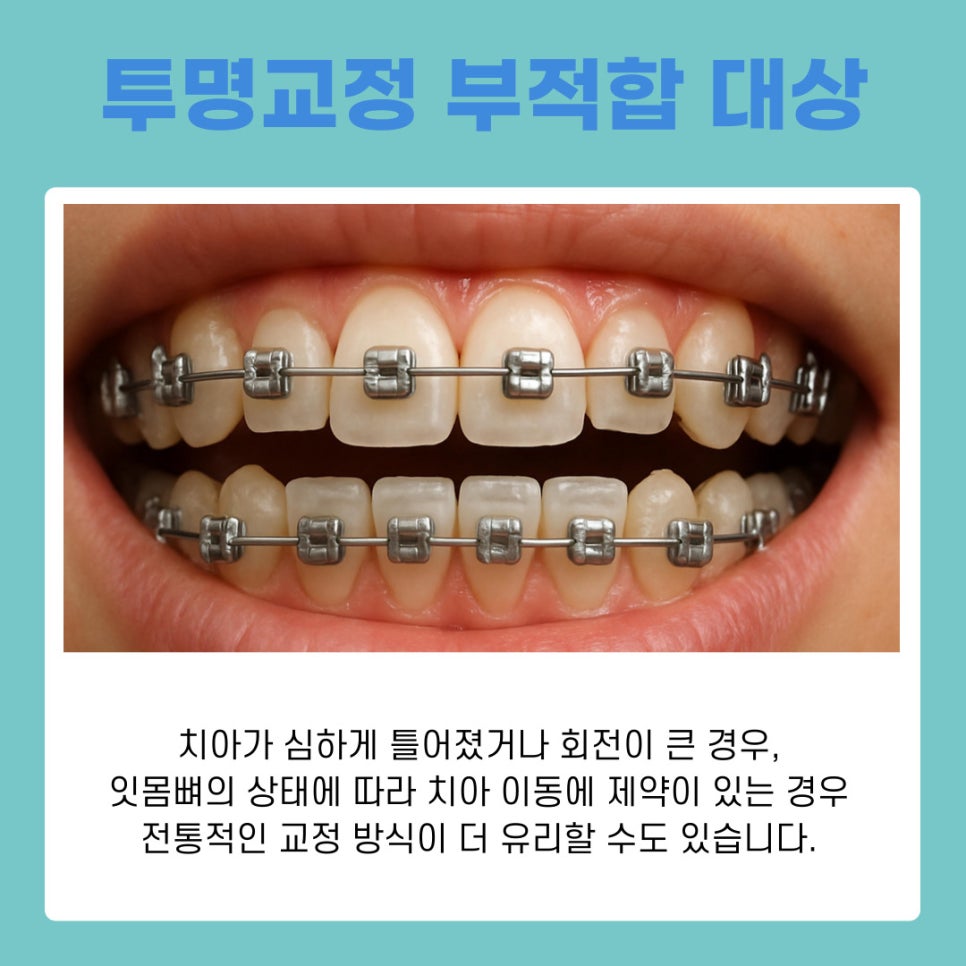 강남역 투명교정 이 부분 놓치면 후회할 수 있습니다 관련 이미지 3