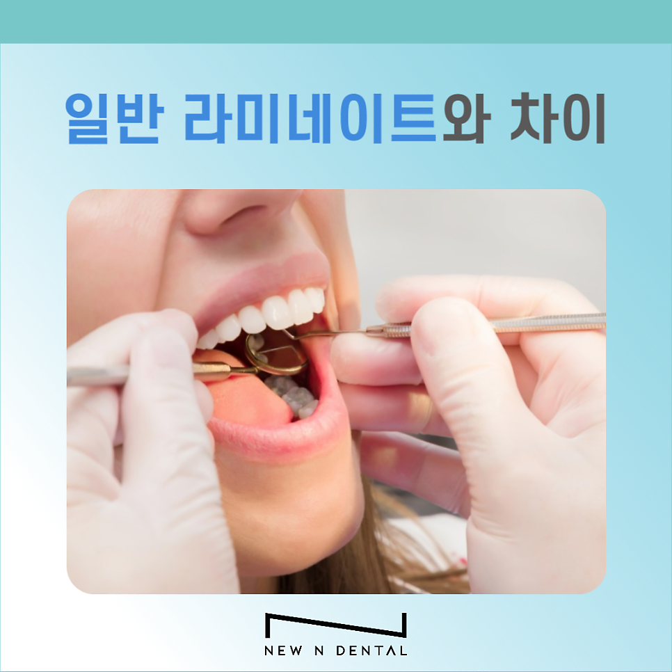 무삭제 라미네이트는 어떤 경우에 적합할까? 관련 이미지 6