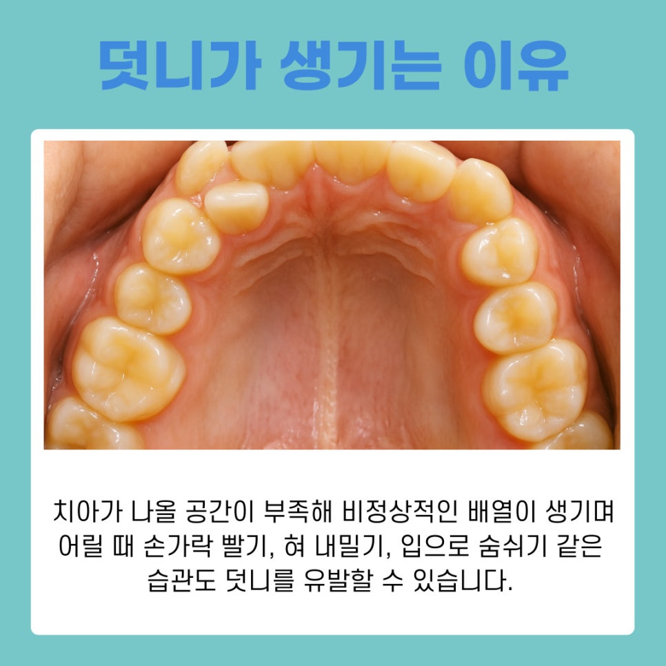 강남역교정치과 덧니발치교정 치아 건강과 심미성 모두 잡는 방법 관련 이미지 3