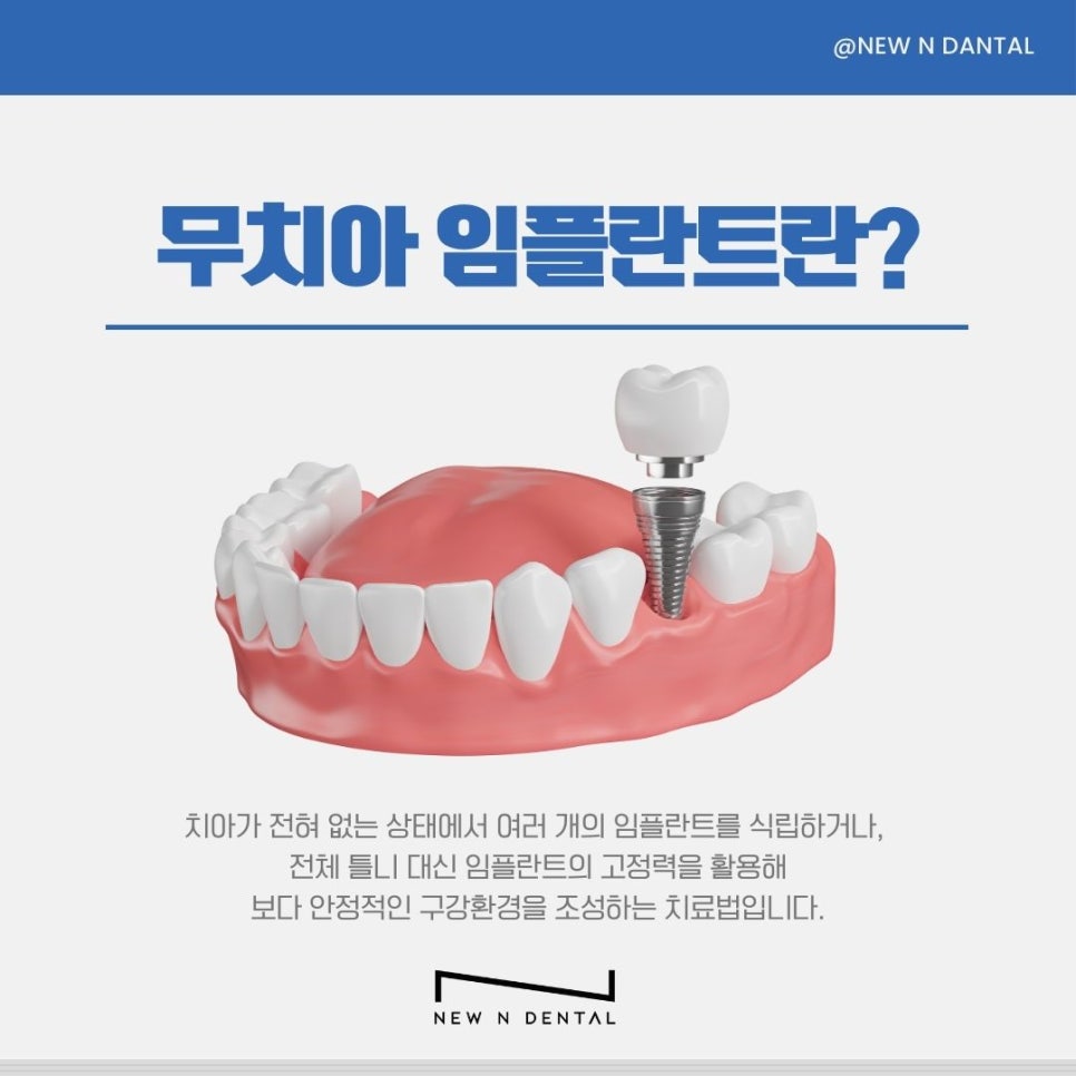 신논현치과 무치아 임플란트, 틀니보다 확실한 선택 관련 이미지 2