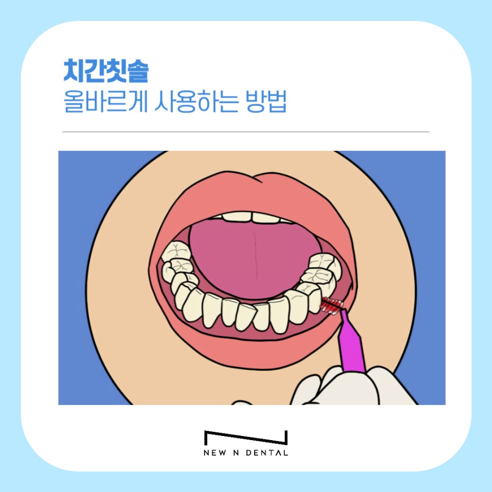 치간칫솔 치아관리 올바르게 사용하려면 관련 이미지 5