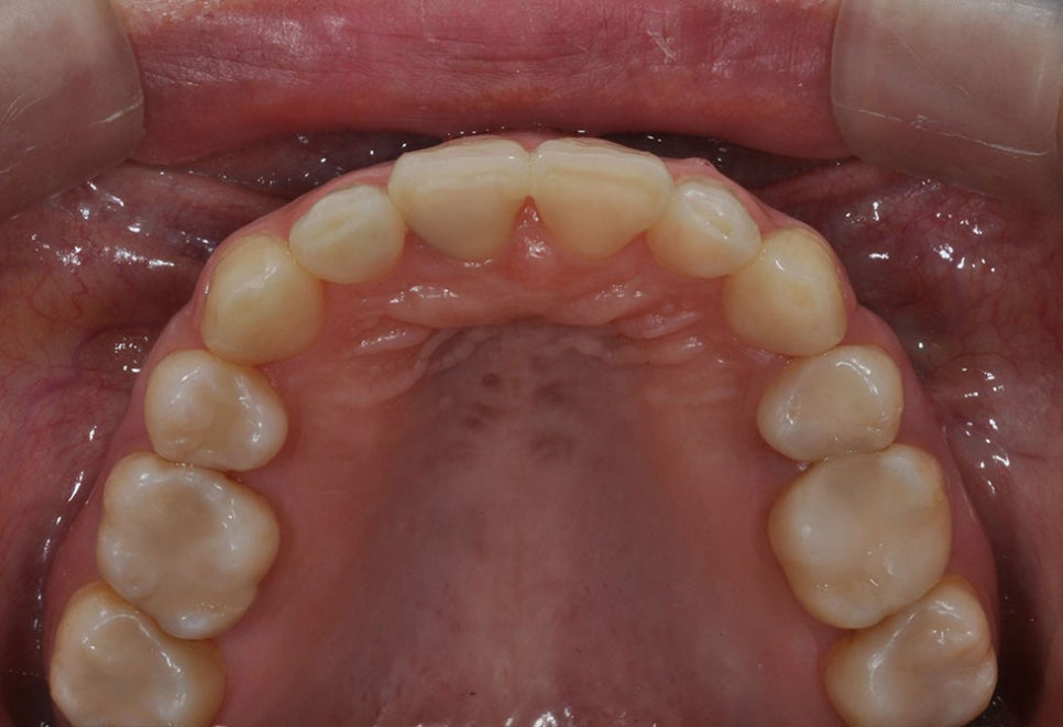역삼동치아교정 똑똑하게 받기 위해 관련 이미지 5