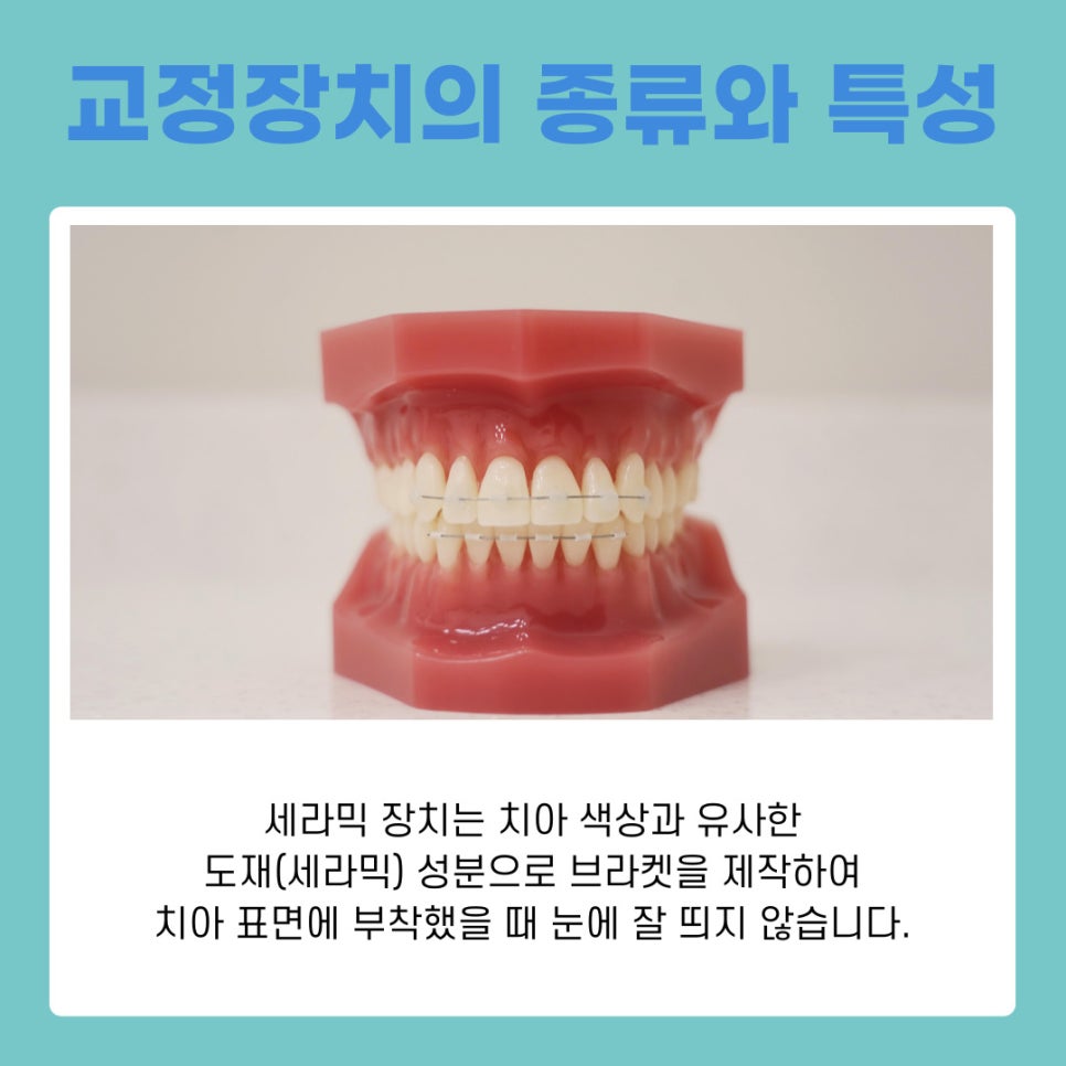 Understanding the Characteristics of Different Types of Orthodontic Appliances at Gangnam Orthodontic Clinics image 8