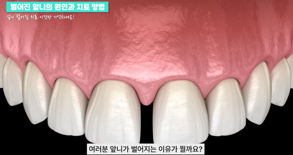 강남역치과 앞니 벌어짐 원인, 치료와 방법 관련 이미지 4