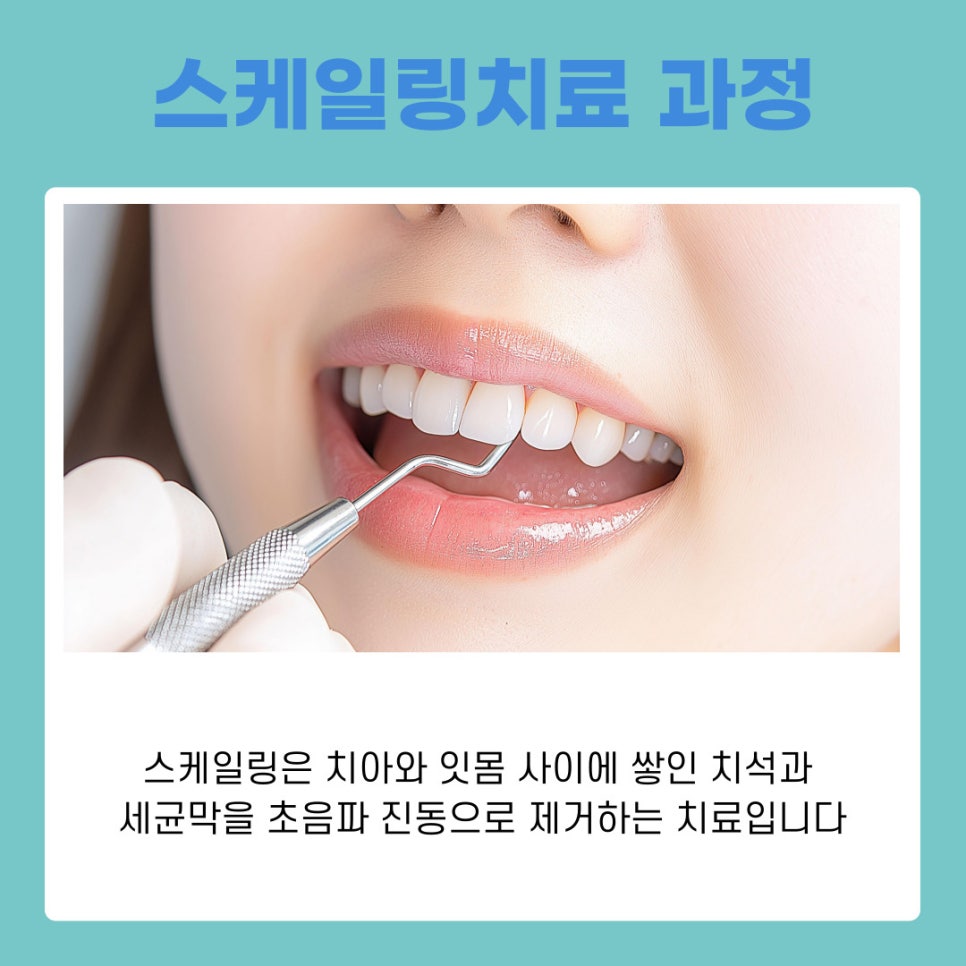 강남역치과 풍치치료법 스케일링으로 잇몸건강 되찾는 법 관련 이미지 5