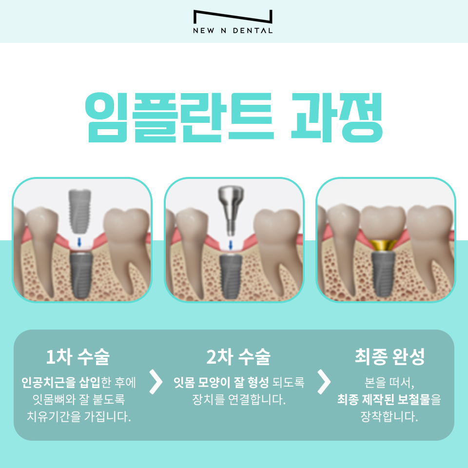 강남임플란트잘하는치과 찾는다면 관련 이미지 4