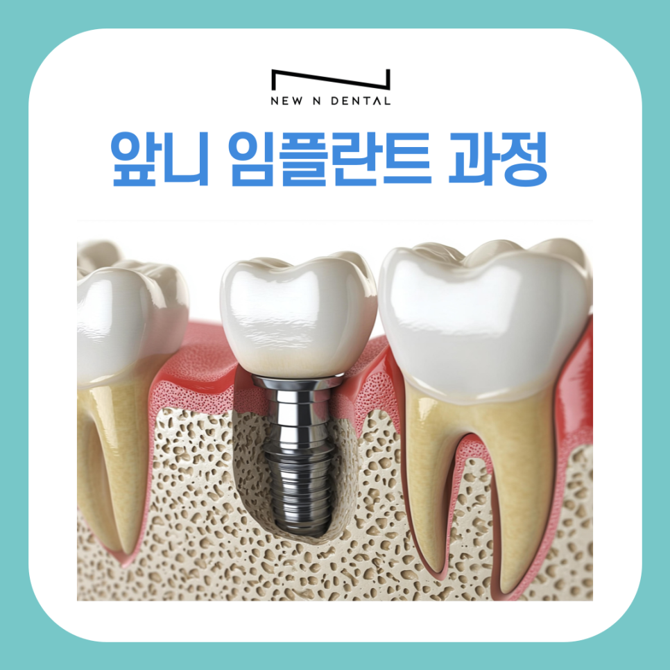 앞니 임플란트 식립 주의해야 할 사항은? 관련 이미지 9