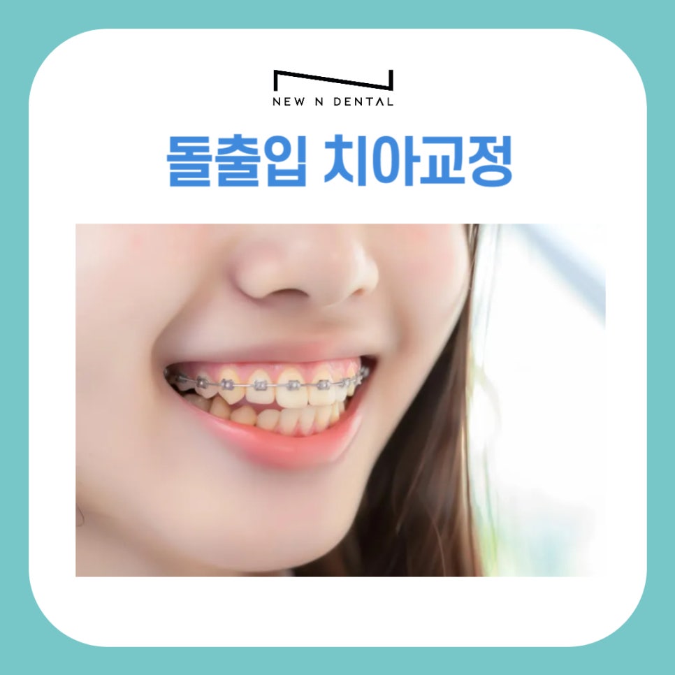 강남 돌출입치아교정 개선하려면 관련 이미지 2