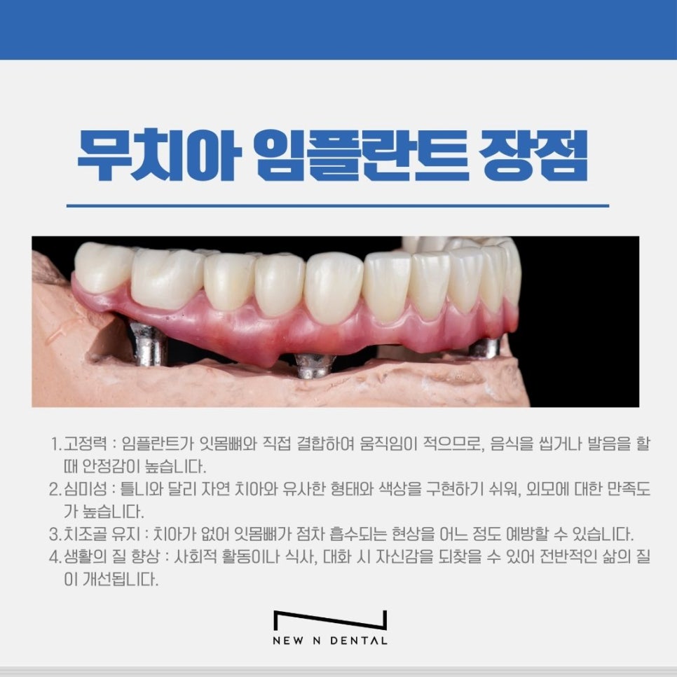 신논현치과 무치아 임플란트, 틀니보다 확실한 선택 관련 이미지 3