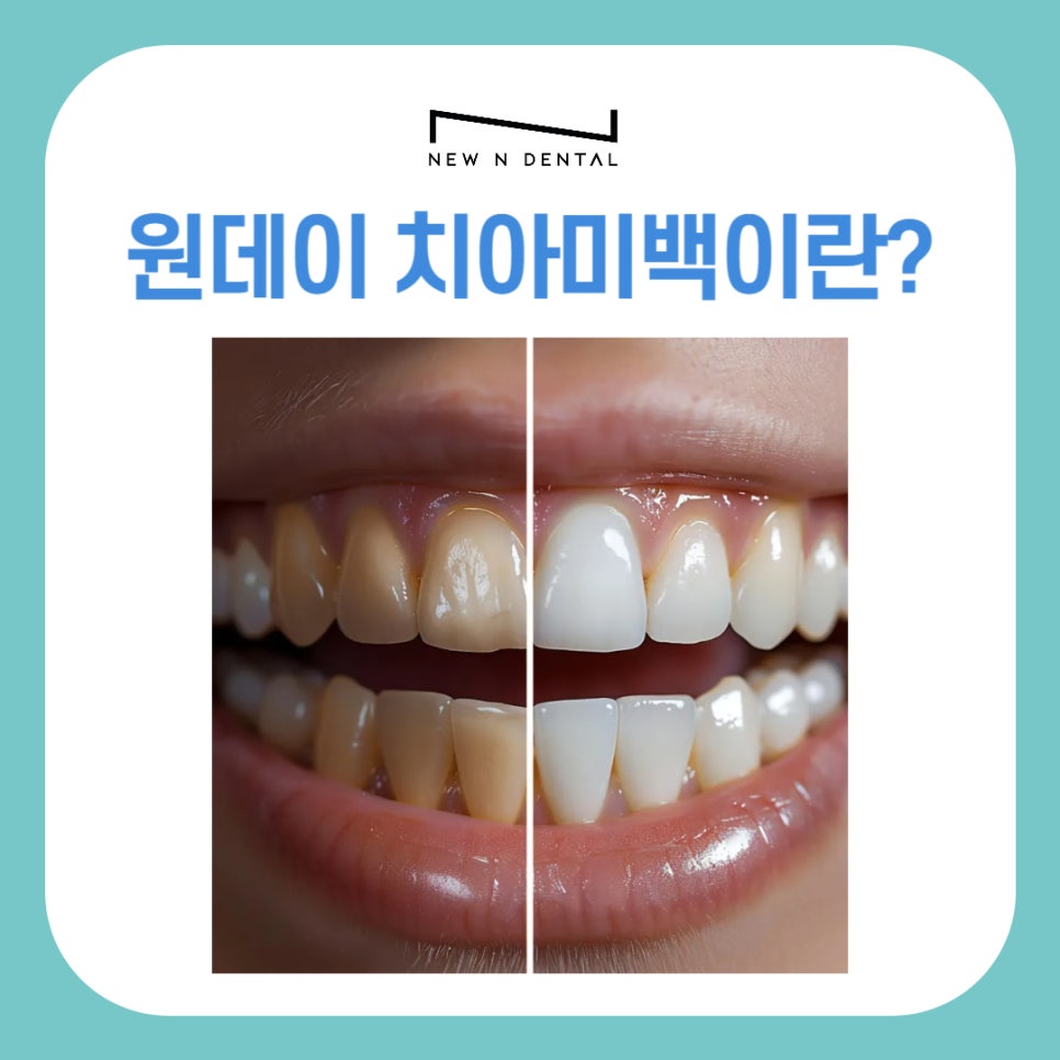 원데이 치아미백 변색의 원인과 후유증 없는 찐후기 관련 이미지 5