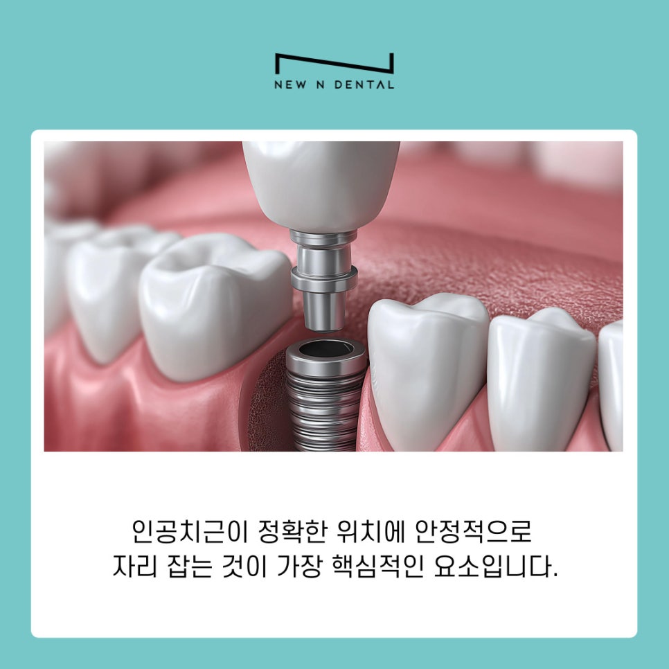 반포역치과 임플란트 치료 기간과 회복 과정 관련 이미지 5