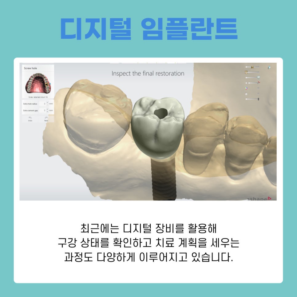 역삼동 임플란트 치아 상태와 생활 습관까지 함께 살펴야 하는 이유 관련 이미지 11