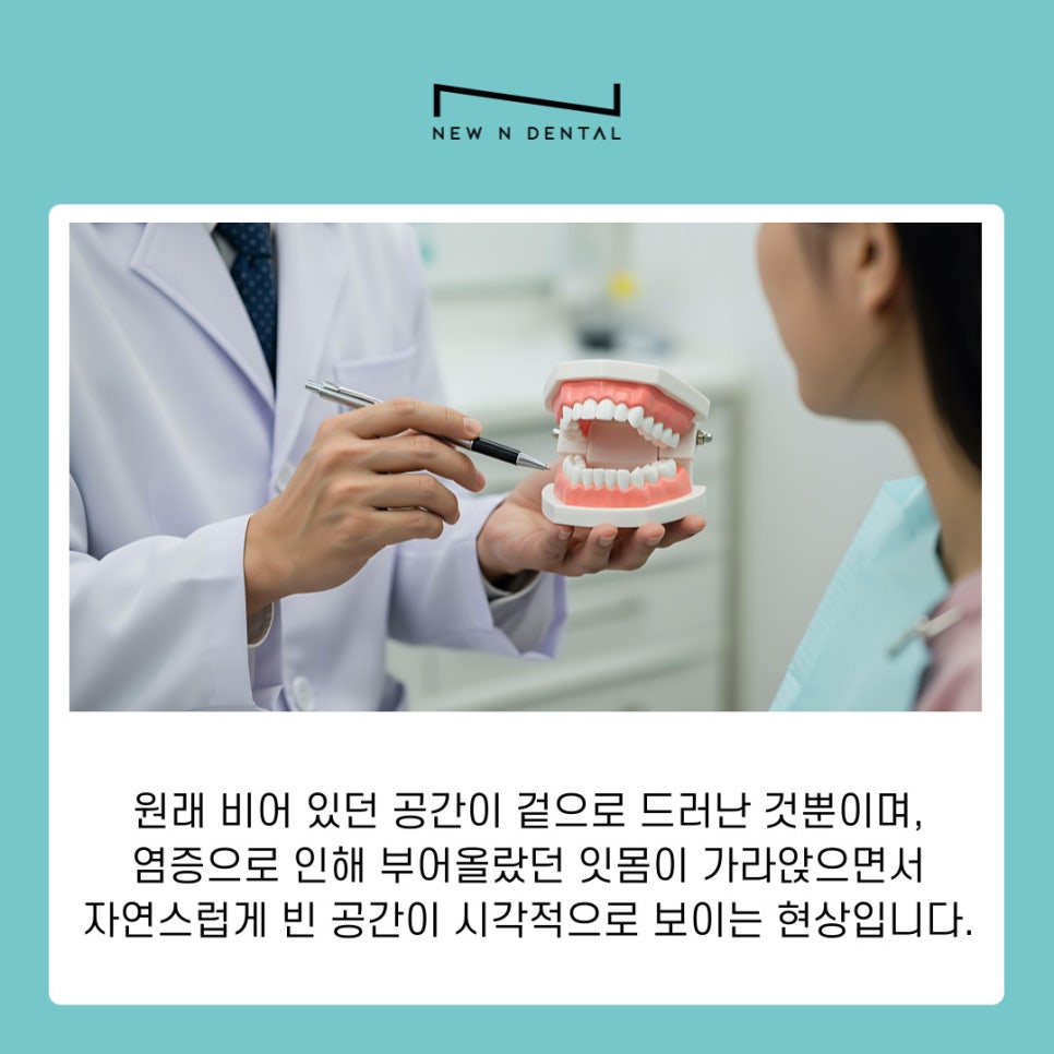 Gangnam Scaling Frequency and Essential Care for Preventing Gum Disease image 9