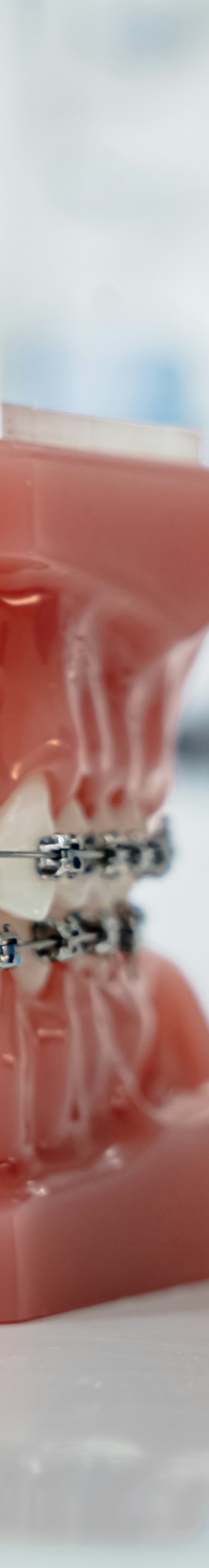 치아교정 종류 장단점 알아보기 관련 이미지 17